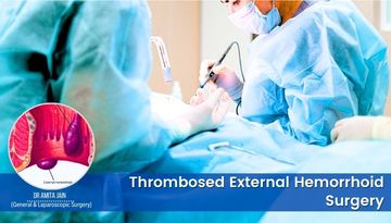 Dr Amita Jain thrombosed External Hemorrhoid Surgery